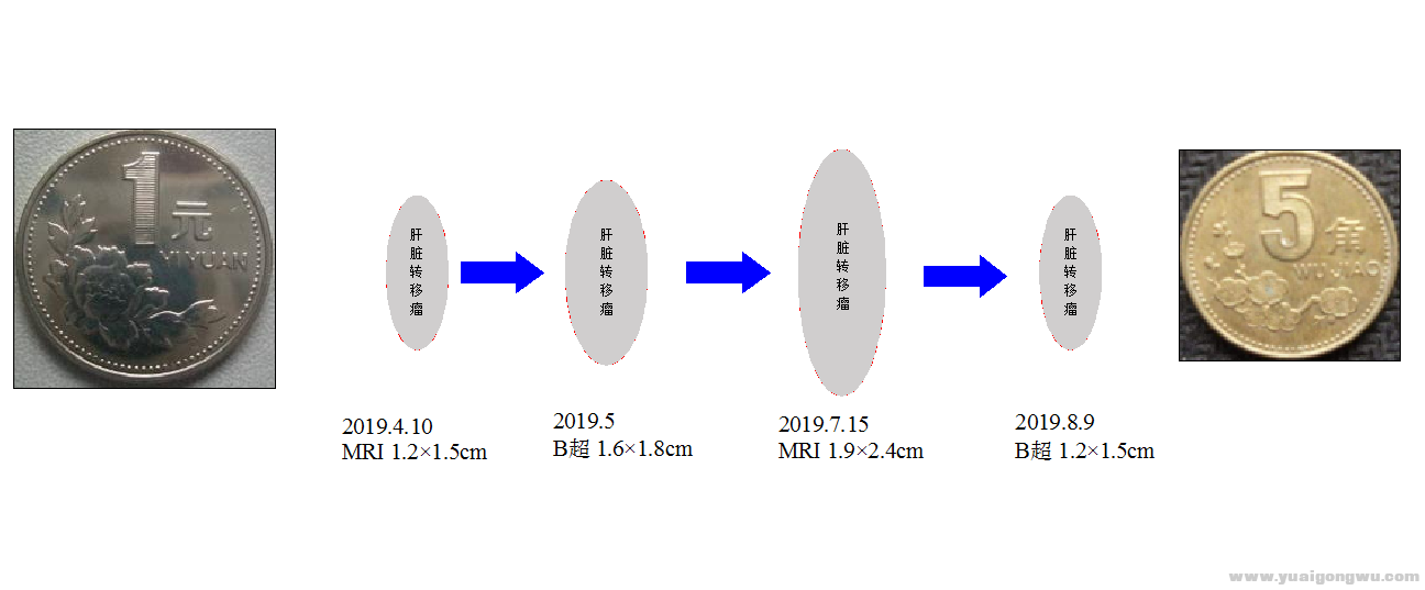 肝转移瘤变化示意图